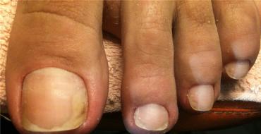 Выявляем признаки грибка на ногтях ног Грибок ногтей на ногах симптомы лечение